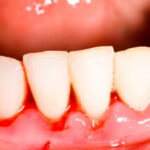 Parodontite e diabete: cause, sintomi e prevenzione della piorrea