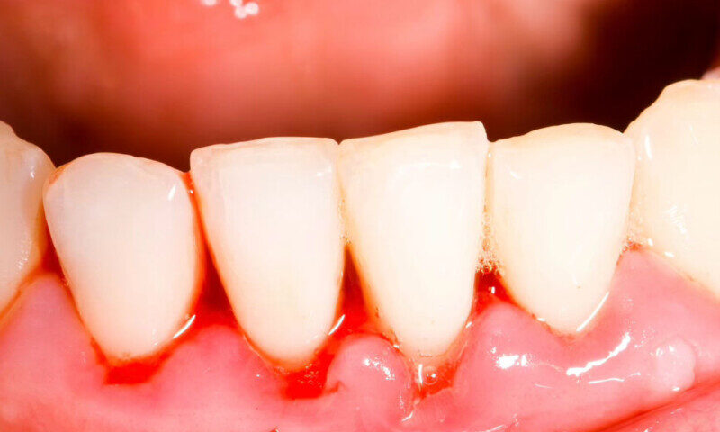 Parodontite e diabete: cause, sintomi e prevenzione della piorrea