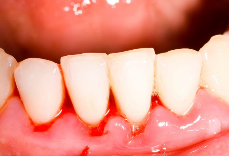 Parodontite e diabete: cause, sintomi e prevenzione della piorrea