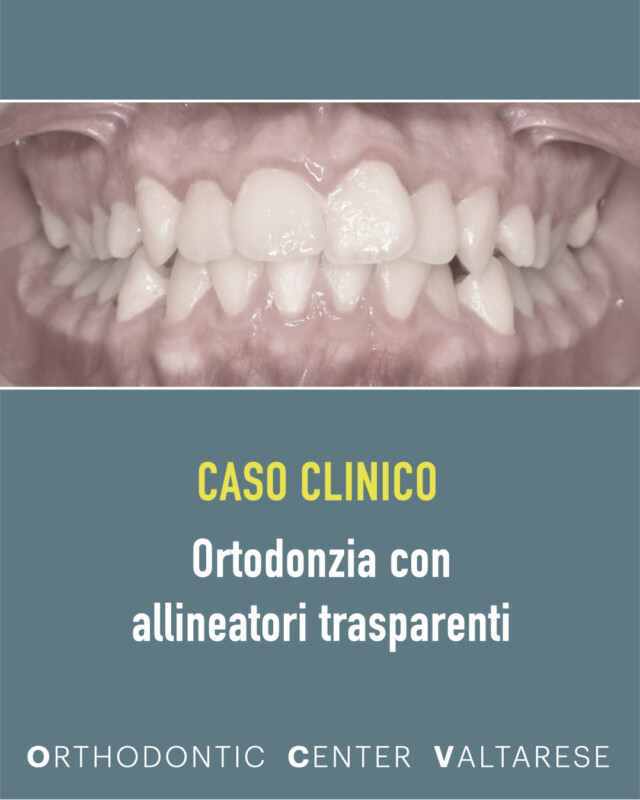 La situazione iniziale di un caso di trattamento con allineatori trasparenti