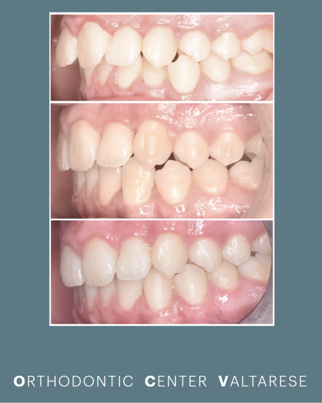 Le fasi di un trattamento di ortodonzia con allineatori trasparenti