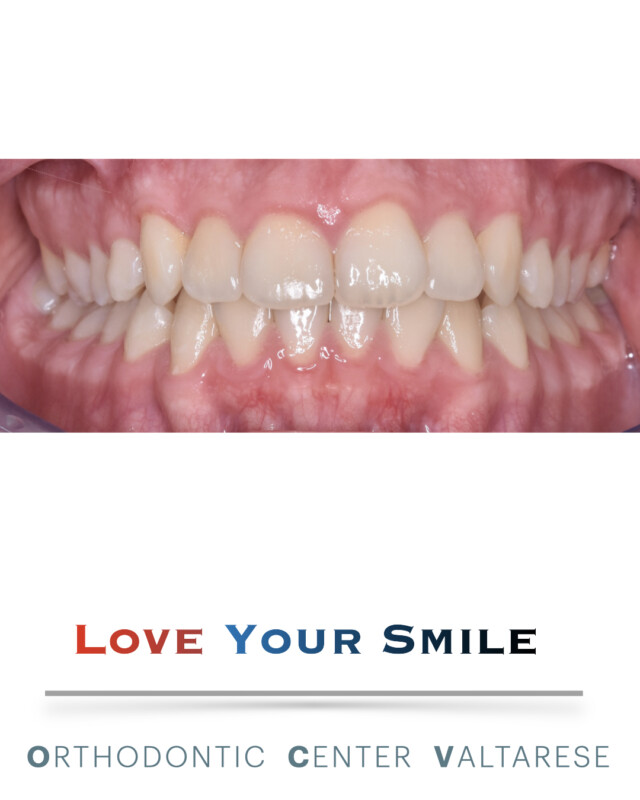 La conclusione di un caso di ortodonzia con allineatori trasparenti