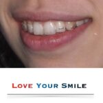 La discrezione delle allineatori trasparenti