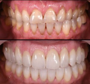 trattamento con faccette dentali