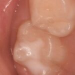 sigillature dentali, sigillatura molari bambini, prevenzione carie bambini, solchi dentali