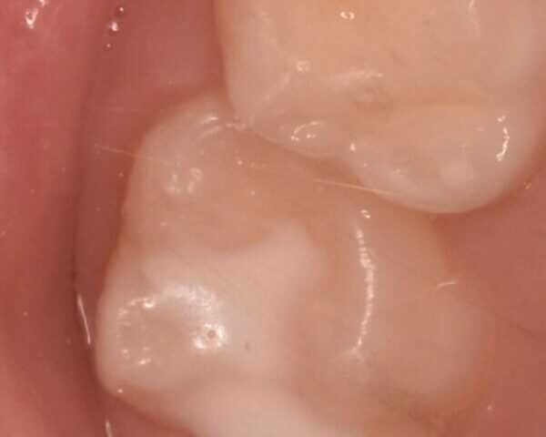 sigillature dentali, sigillatura molari bambini, prevenzione carie bambini, solchi dentali